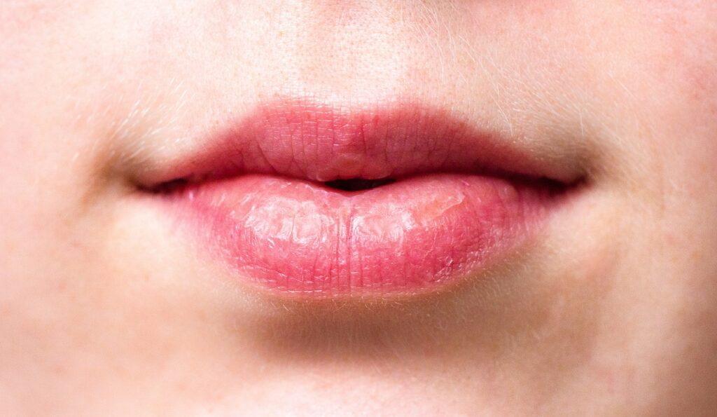mouth, lips, dry lips-2160205.jpg
